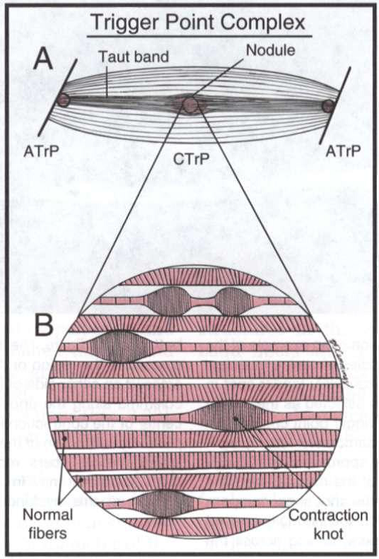 Myofascial Trigger Points (EXPLAINED)